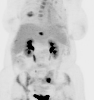 PET Scan showing diffuse bony metastasis